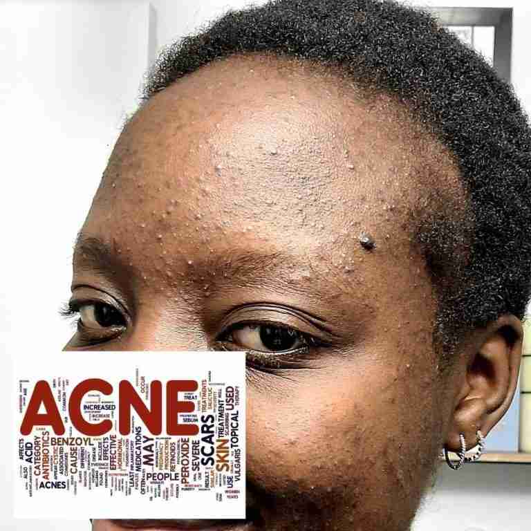 acne treatment